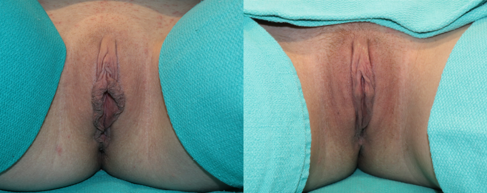 Labiaplasty case #262971
