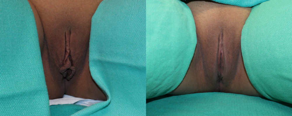 Labiaplasty case #262880