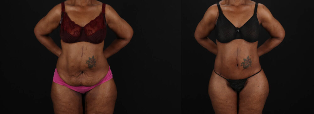 Post Bariatric Surgery (Massive Weight Loss) case #262974