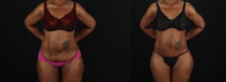 Post Bariatric Surgery (Massive Weight Loss) case #262974