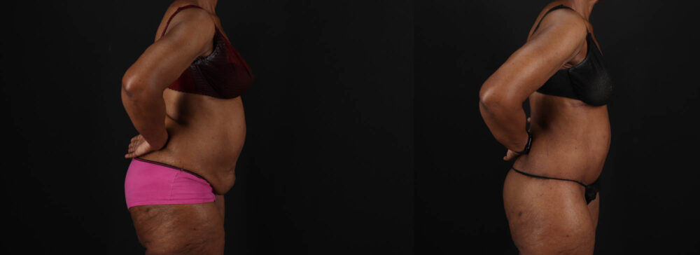 Post Bariatric Surgery (Massive Weight Loss) case #262974