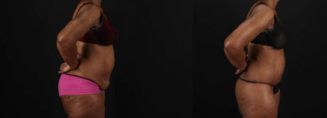 Post Bariatric Surgery (Massive Weight Loss) case #262974