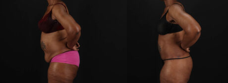 Post Bariatric Surgery (Massive Weight Loss) case #262974