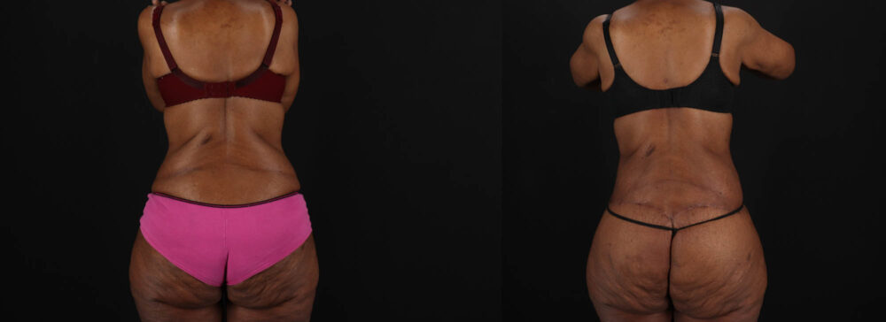 Post Bariatric Surgery (Massive Weight Loss) case #262974