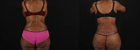 Post Bariatric Surgery (Massive Weight Loss) case #262974