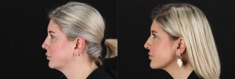 Renuvion RF Skin Tightening case #263029