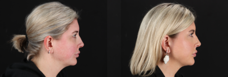 Renuvion RF Skin Tightening case #263029