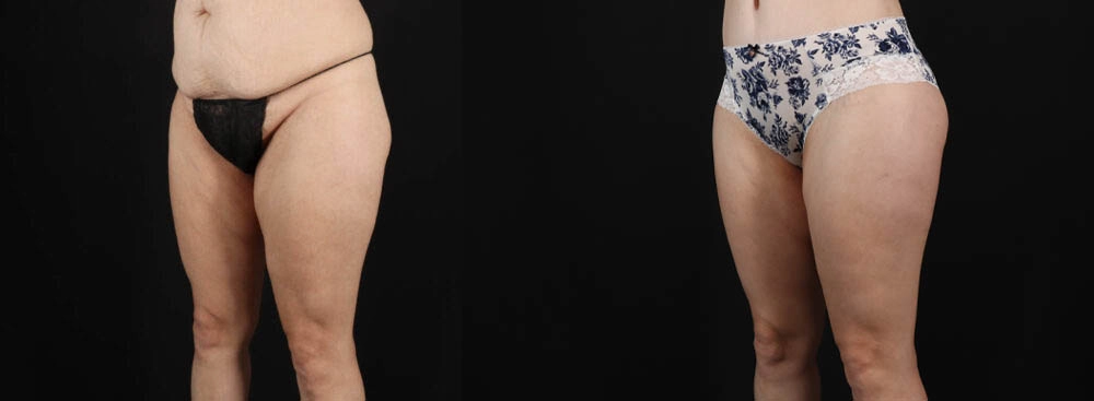 Tummy Tuck case #263466