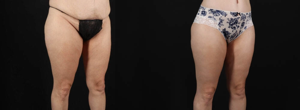 Tummy Tuck case #263466