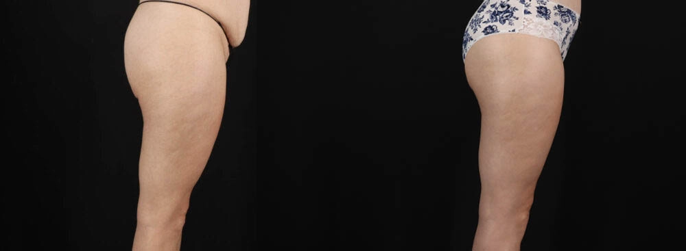 Tummy Tuck case #263466