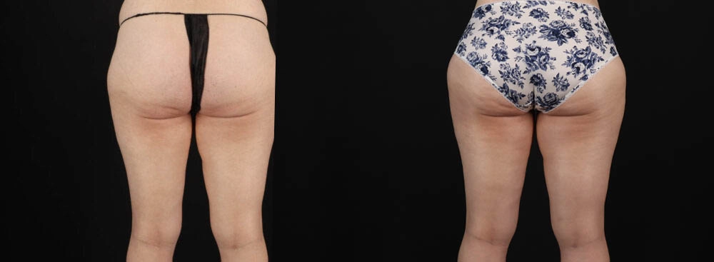 Tummy Tuck case #263466