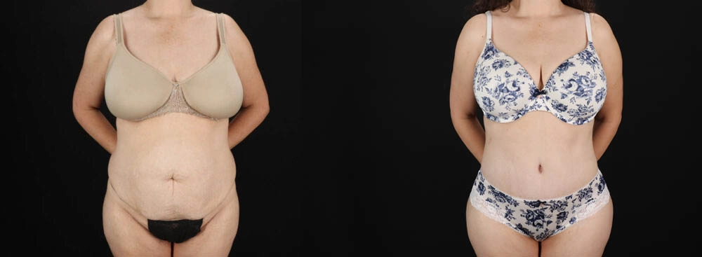 Tummy Tuck case #263466