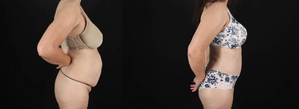 Tummy Tuck case #263466