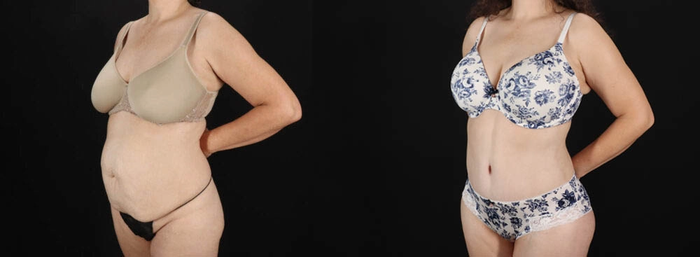 Tummy Tuck case #263466