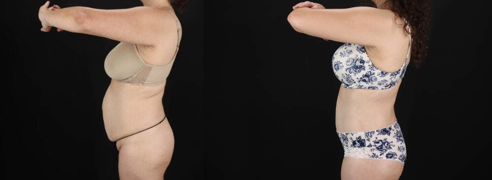 Tummy Tuck case #263466