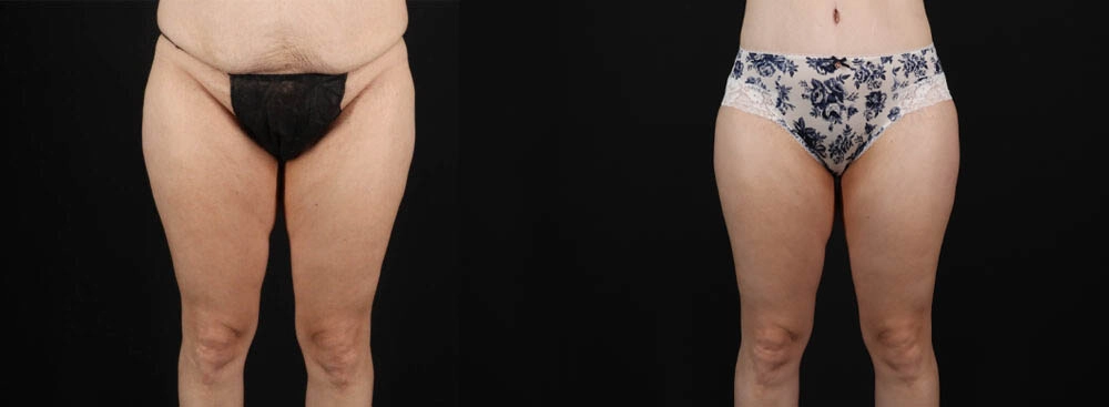 Tummy Tuck case #263466