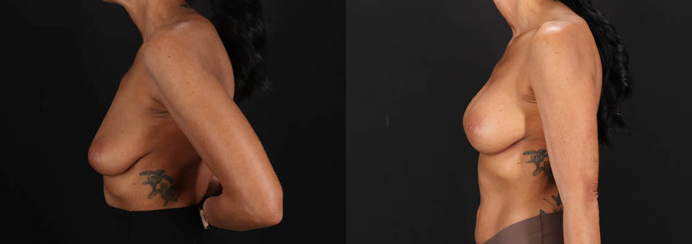 Breast Augmentation case #263455