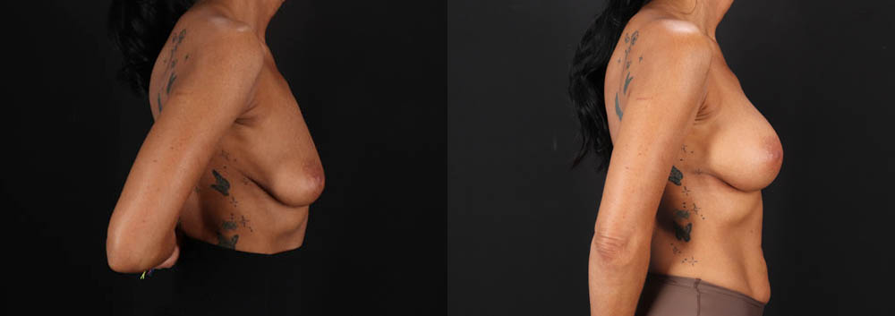 Breast Augmentation case #263455