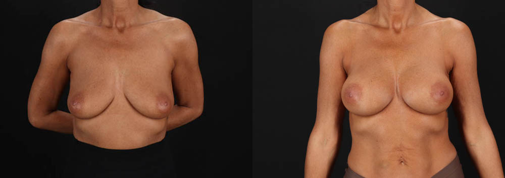 Breast Augmentation case #263455