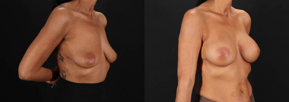 Breast Augmentation case #263455