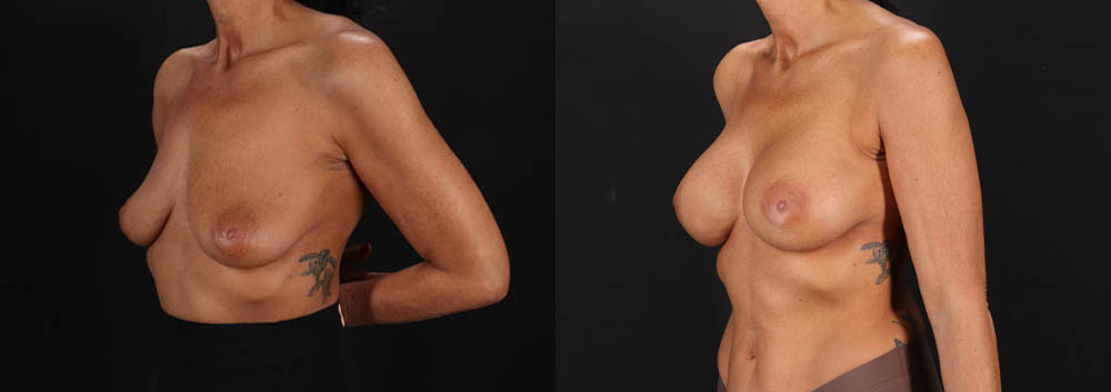 Breast Augmentation case #263455
