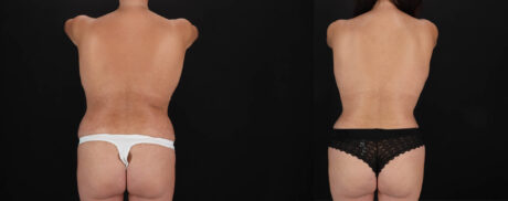 Mommy Makeover case #263966