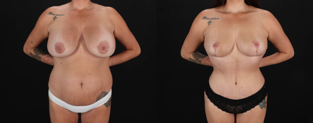 Mommy Makeover case #263966