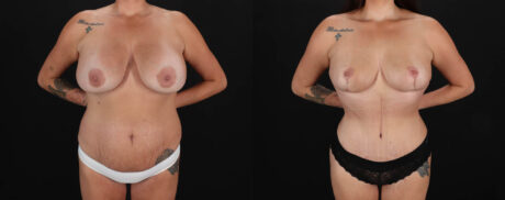 Mommy Makeover case #263966