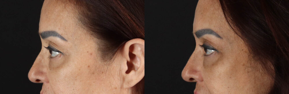 Blepharoplasty case #263975