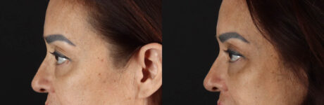 Blepharoplasty case #263975