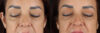 Blepharoplasty case #263975 slider thumbnail