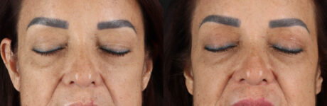 Blepharoplasty case #263975
