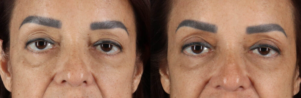 Blepharoplasty case #263975