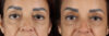 Blepharoplasty case #263975 slider thumbnail