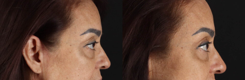 Blepharoplasty case #263975