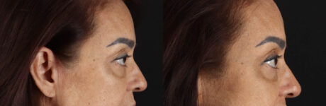 Blepharoplasty case #263975
