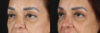 Blepharoplasty case #263975 slider thumbnail