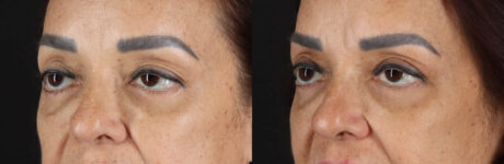 Blepharoplasty case #263975
