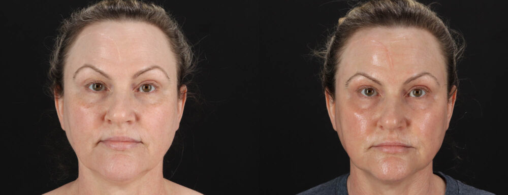 Co2 Laser case #263481