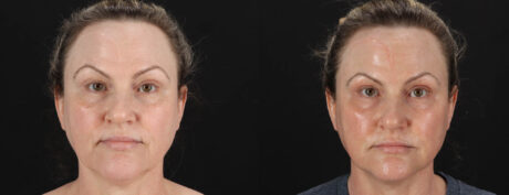 Co2 Laser case #263481