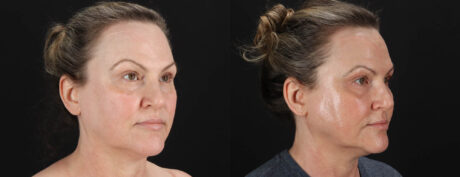 Co2 Laser case #263481