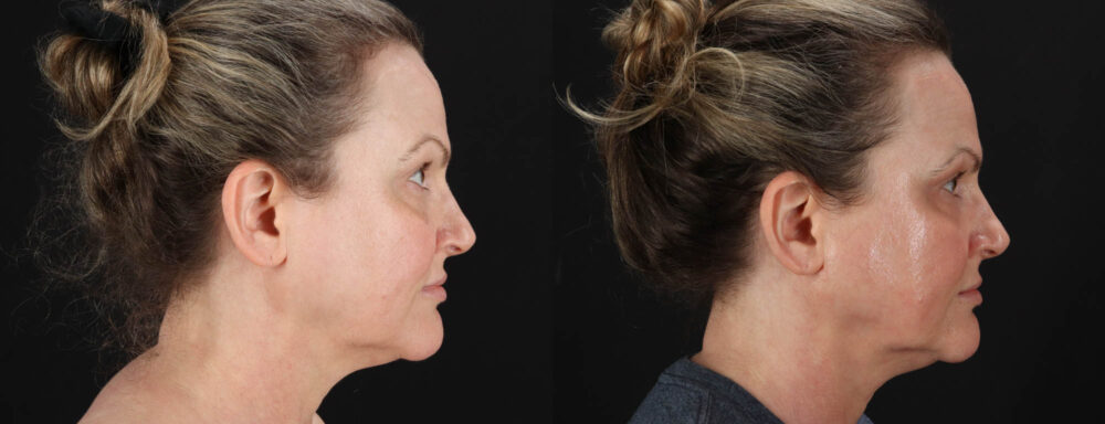 Co2 Laser case #263481