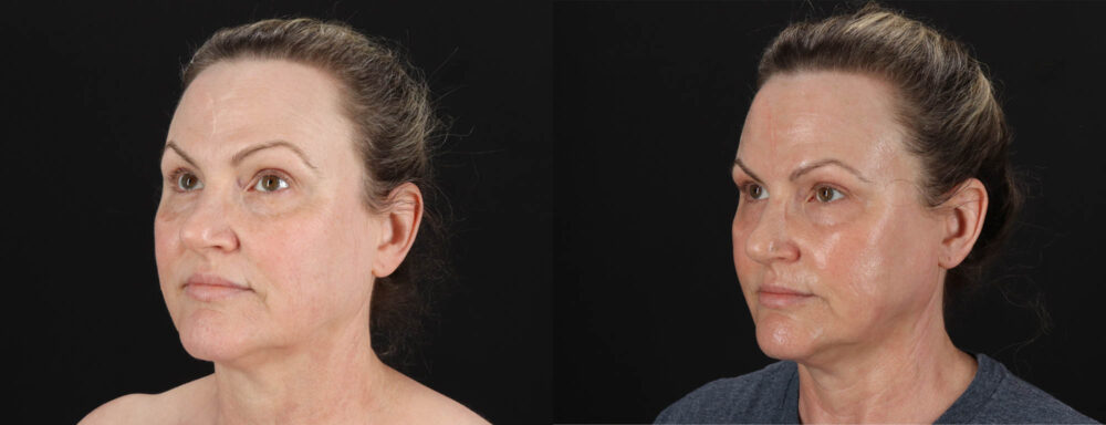 Co2 Laser case #263481