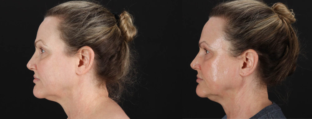 Co2 Laser case #263481