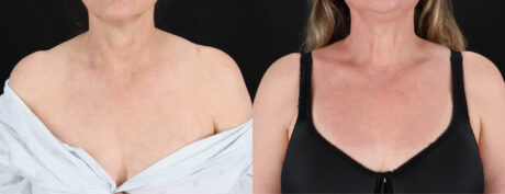 Co2 Laser case #263481