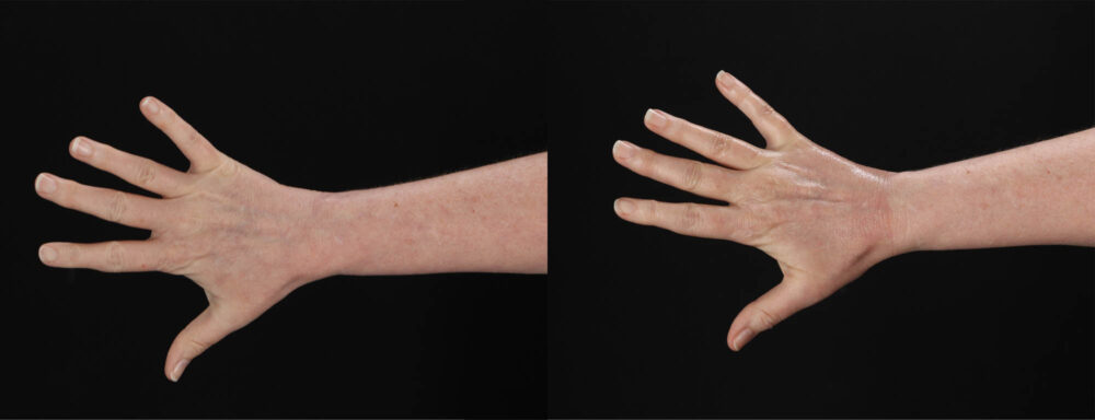 Co2 Laser case #263481