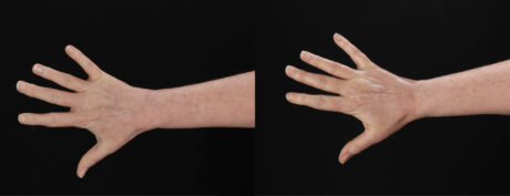 Co2 Laser case #263481