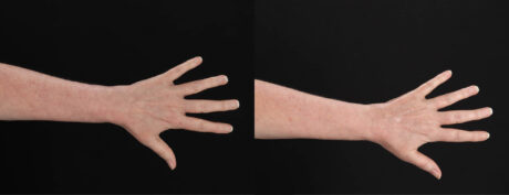 Co2 Laser case #263481