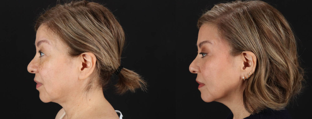 Quantum RF case #263448