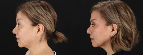 Quantum RF case #263448